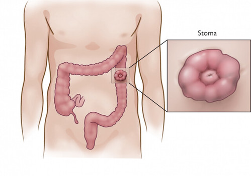 colostomia